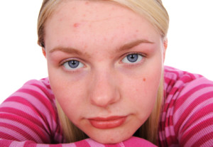 girl.acne